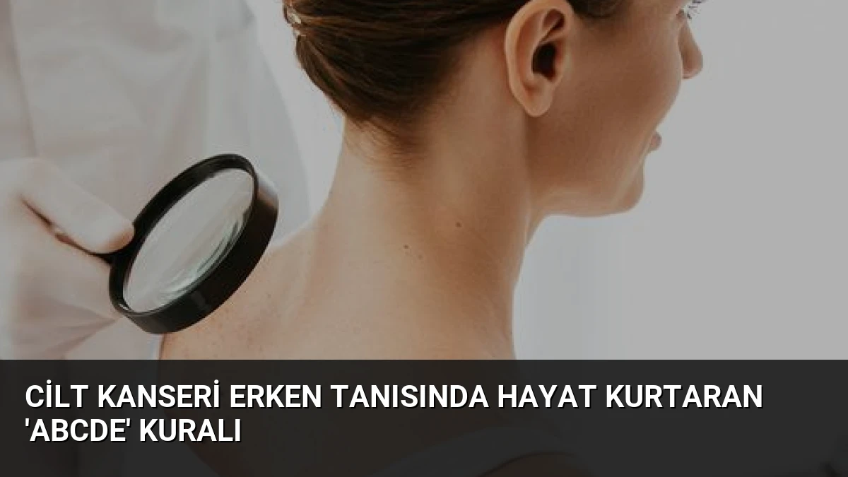 Cilt Kanseri Erken Tanısında Hayat Kurtaran ‘ABCDE’ Kuralı